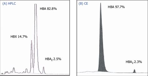 A An Abnormal Peak Was Distinguished From Hb A By HPLC And Amounted To