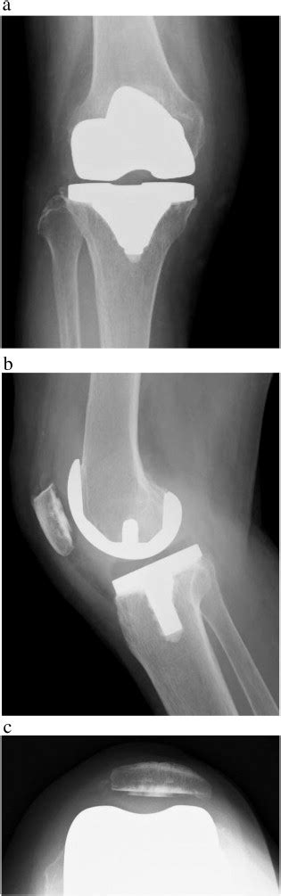 Recurrent Hemarthrosis After Total Knee Arthroplasty Caused By The