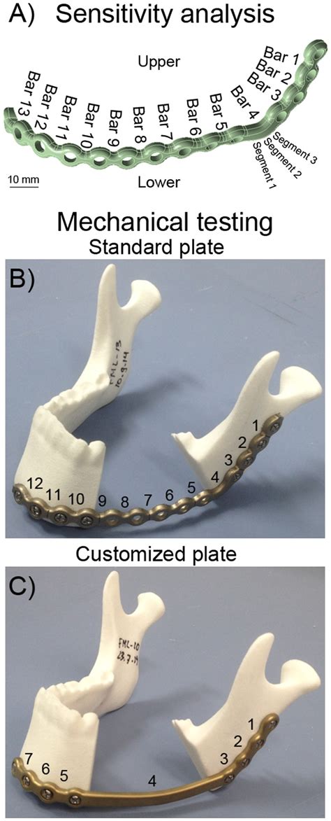 Customized Mandibular Reconstruction Plates Improve Mechanical