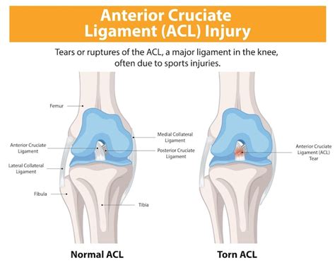 Página 3 Lesao Ligamento Cruzado Anterior Imagens Download Grátis