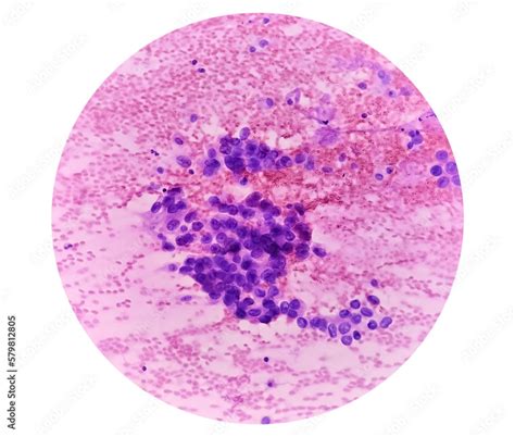 Photomicrograph Of Fine Needle Aspiration Fna Cytology Of A Pulmonary