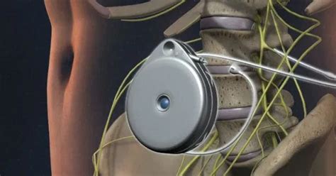 Pain Pump Implant Cost Medicare Trials At Usa Spine Care