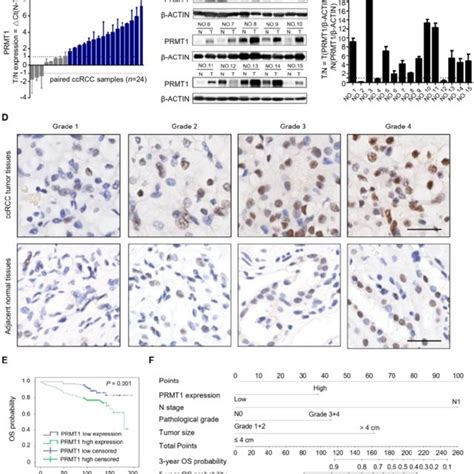 High Expression Of Prmt1 Correlates With Tumor Progression And