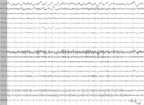 JLE Epileptic Disorders Self Stimulation In An Adult Misdiagnosed