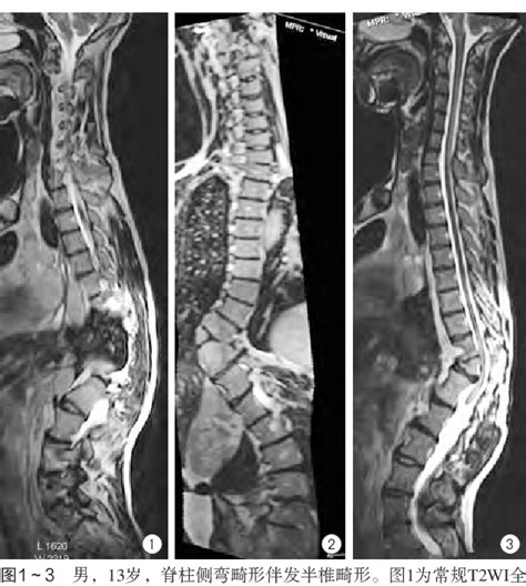 Figure From Vista Sequence Magnetic Resonance Imaging Evaluation Of