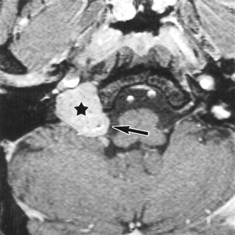 Primary Jugular Foramen Meningioma Imaging Appearance And