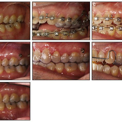 A A 40 Year Old Man With An Anterior Open Bite With Occlusion Only On