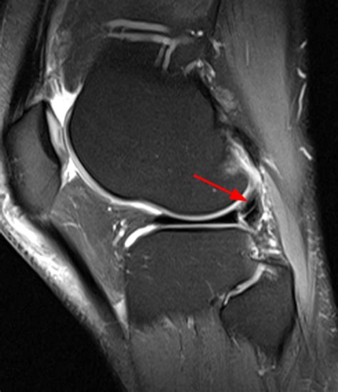Pathology of the Popliteus Tendon | Radsource