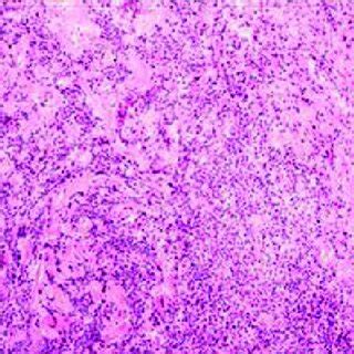 Immunohistochemical Study Showing Diffuse Positivity Of Diffuse Round