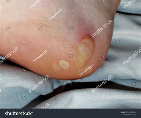 154 Epidermolysis Bullosa Stock Photos Images Photography Shutterstock