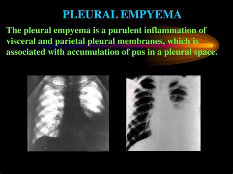 Ppt Purulent Disease Of The Lungs And Pleura Diseases Of The