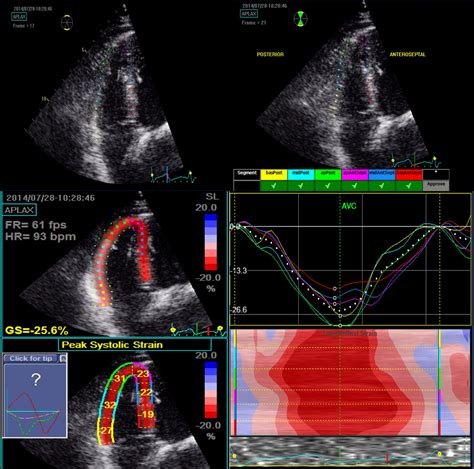 Echocardiographic Assessment of Right Ventricular Function by Two ...