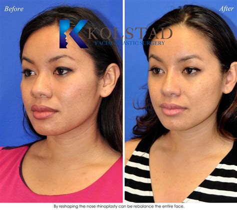 Asian Rhinoplasty Before And After Gallery Dr Kolstad San Diego