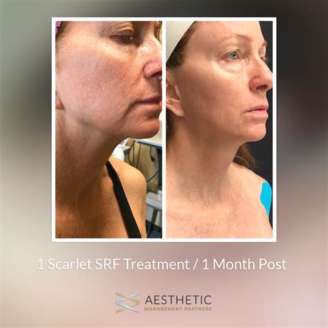 Scarlet SRF Facial Treatment Revivify Medical Spa