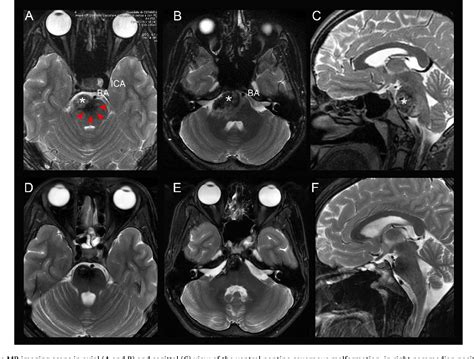 Figure From Endoscopic Endonasal Transclival Approach To A Pontine