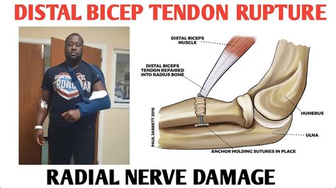 I Ruptured My Distal Bicep Tendon (Recovery & Surgery) - YouTube