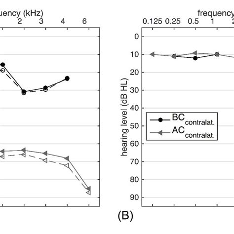 Average Pure Tone Air Conduction Ac And Bone Conduction Bc Download Scientific Diagram