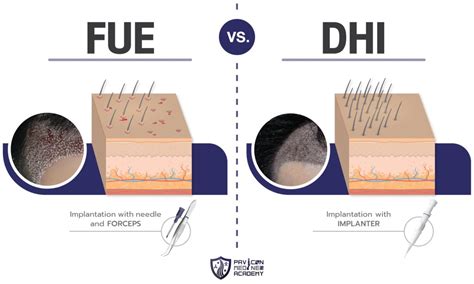 DHI Hair Transplant Pavicon Mediness Center