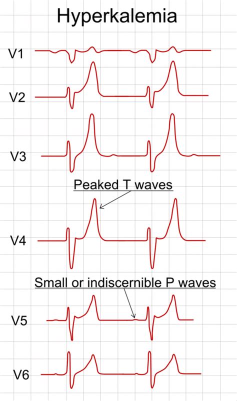 Hyperkalaemia Ecg Features Management Teachmesurgery