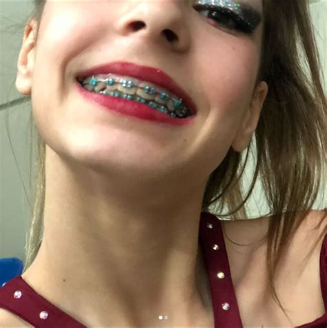 Pin By Evil H On Beautiful Braces Braces Girls Dental Braces Cute