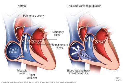 Guide To Heart Murmurs Tricuspid Regurgitation Murmur Stepwards