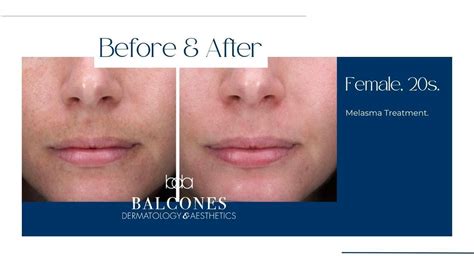 MELASMA Before & After Gallery - Austin, TX: Balcones Dermatology ...