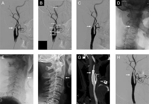 Proximal Migration Of A Tapered Open Cell Stent After Carotid Artery