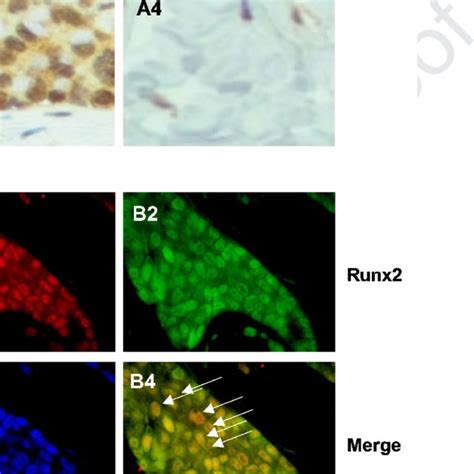 Colocalization Of Brf1 And Runx2 In Human Biopsy Of Breast Cancer A