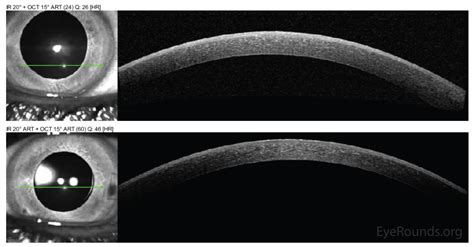 Meesmann Epithelial Corneal Dystrophy