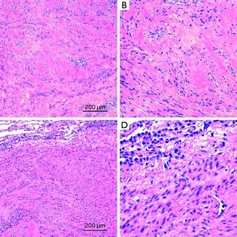 Hematoxylin Eosin Staining Showed A 100× B 400× The Uterine Tumor