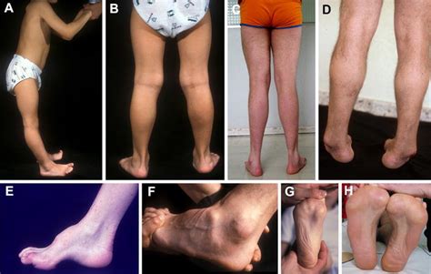 New Insights Into The Pathophysiology Of Pes Cavus In Charcot Marie Tooth Disease Type 1a