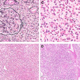 Light Microscopy Of Samples From Renal Biopsy Only A Glomerulus Showed