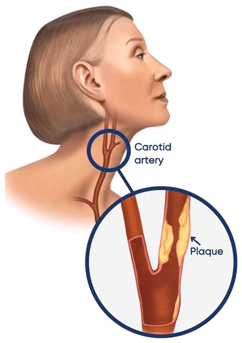 Stroke TIA Carotid Artery Disease I Dr Mayo Theivendran