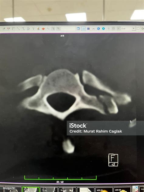 A 50yearold Male Patient With A Fracture In The Vertebral Lamina After A Motorcycle Accident In ...