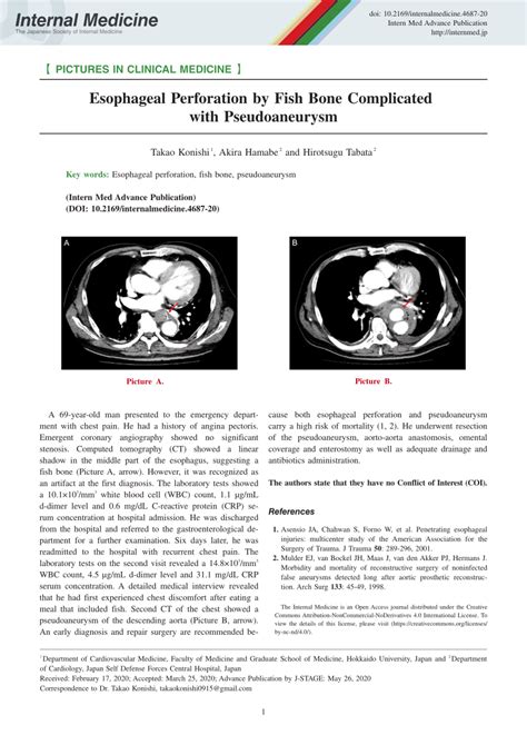 Pdf Esophageal Perforation By Fish Bone Complicated With Pseudoaneurysm