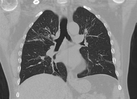 Figure Chest Ct Showing Upper Lobe Bronchiectasis In A Patient With Bronchial Asthma