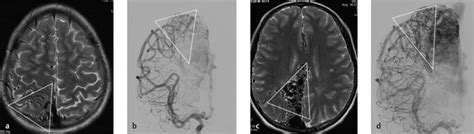 5 Cerebral Arteriovenous Malformations Avms And Dural Arteriovenous Fistulas Davfs