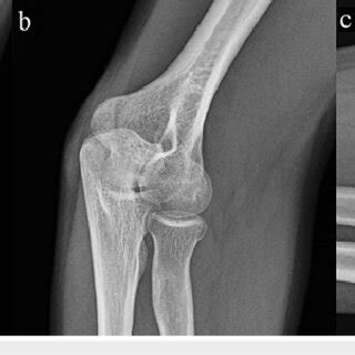 Preoperative Radiographs Of The Left Elbow Anteroposterior A Oblique