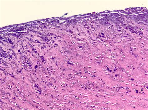 Pathology Outlines Acanthamoeba Keratitis