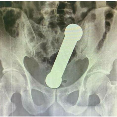 Pelvic Radiography Antero Posterior View Showing A Foreign Body Download Scientific Diagram