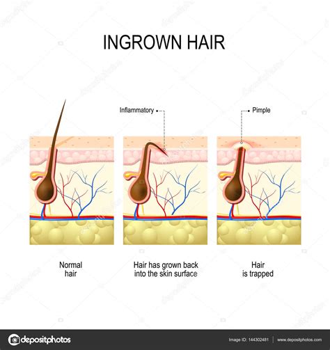 Infected Ingrown Hair Cyst Pictures Pin On Beauty And Health Foto Sex Woman