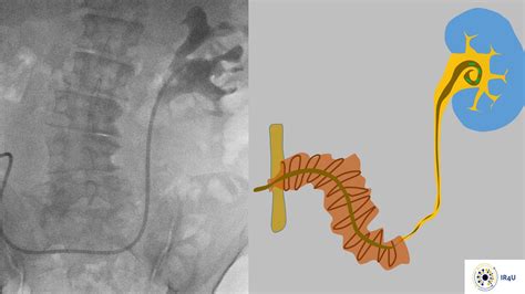 Case 103 Trans Stomal Ureteric Stent Retrieval Ir 4 U