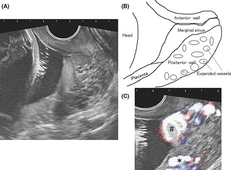 Transvaginal Ultrasonography A Transvaginal Sonography Of The