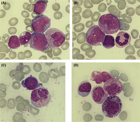 Bone Marrow Aspirate Smear Performed At Admission May Grunwaldgiemsa