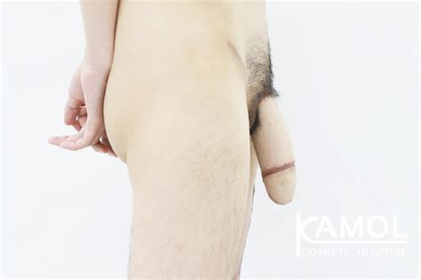 阴茎成形 Kamol Cosmetic Hospital