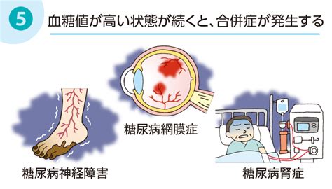 糖尿病の初期症状