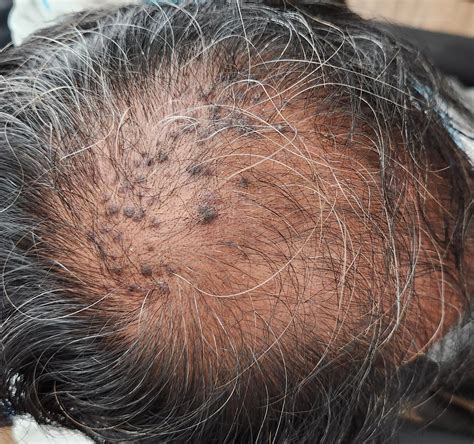 Any Ideas What Are These Black Spots On The Scalp Rhairloss