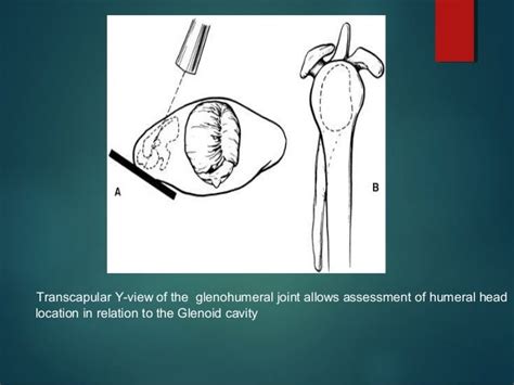 Shoulder Instability