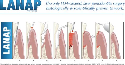 Lanap The Ultimate Guide To Laser Therapy For Treating Gum Disease