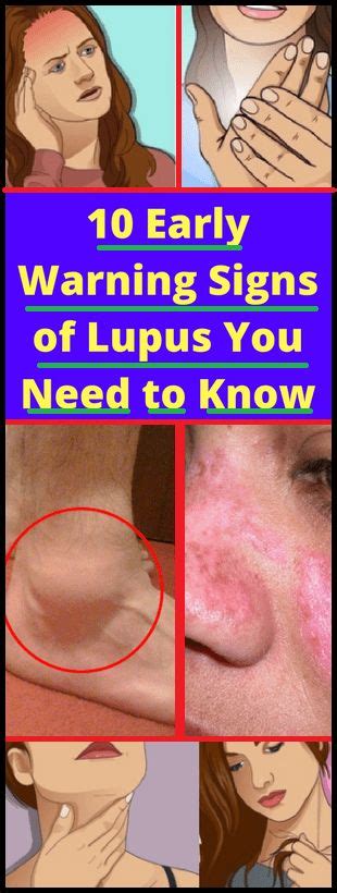 10 Early Warning Signs Of Lupus You Need To Know Warning Signs Medical Problems Health Disease